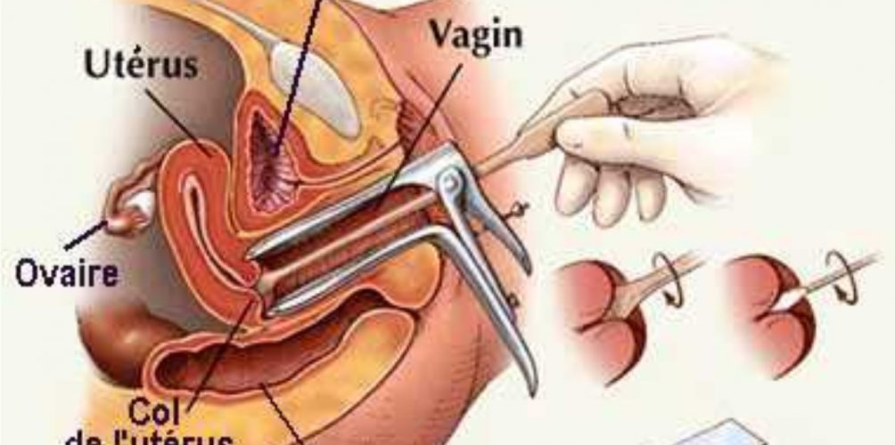 احمي نفسك  لالة مولاتي من سرطان عنق الرحم frottis