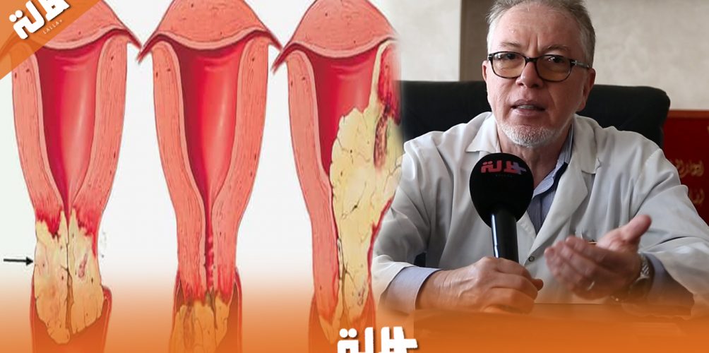 احذري سيدتي..أشياء بسيطة قد تسبب سرطان عنق الرحم!‎