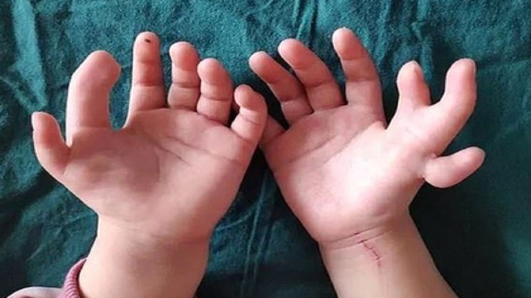 ولدت بـ 14 إصبعا.. أطباء ينجحون في إزالة أصابع زائدة لطفلة