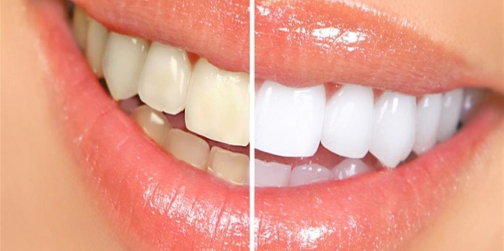 للتخلص من إصفرار الأسنان طبيعيا.. اتبعي هذه الوصفات