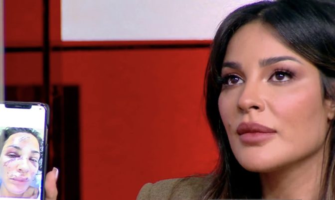 بالدموع.. نادين نجيم تتقاسم لأول مرة تفاصيل إصابتها في حادث مرفأ بيروت (فيديو)