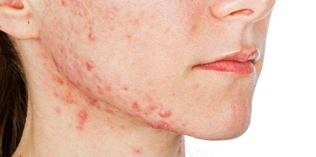 للتخلص من الالتهابات الجلدية.. تجنبوا هذه المواد الغذائية!