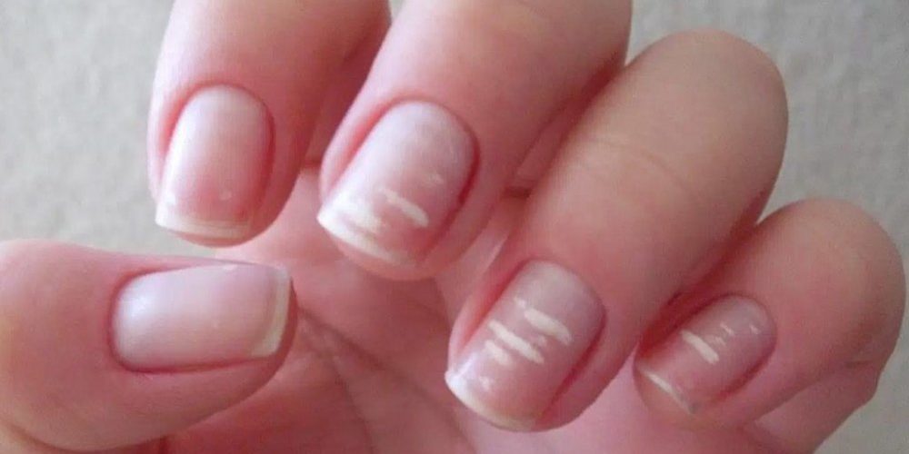 على الأظافر.. عارض جديد للإصابة بكورونا