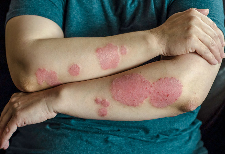 في يومه العالمي.. مختصون يدعون إلى التغطية الصحية لمرضى « الصدفية »