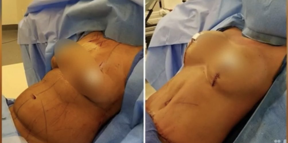 أخصائية في التجميل: أغلبية النساء فالمغرب كيديرو شفط الدهون ونحت الجسد وتكبير المؤخرة