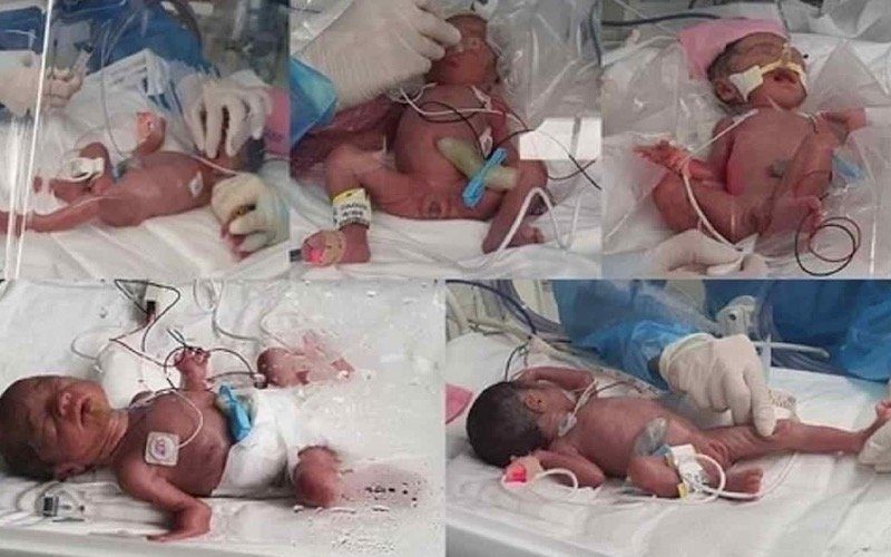 لأول مرة منذ 34 عاما.. امرأة تُنجب 5 توائم في كوريا