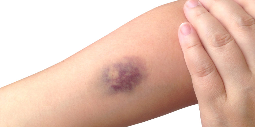 قد تشير إلى الإصابة بسرطان الدم.. أسباب بسيطة وخطيرة للبقع الزرقاء على الجسم