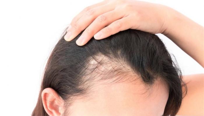 لتفادي تساقط الشعر والصلع.. احرصوا على تناول هذا الفيتامين