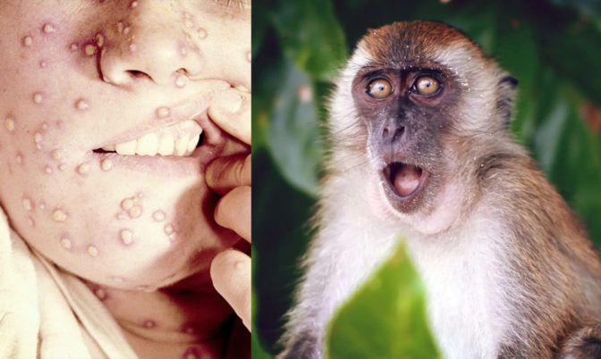 ينتقل عبر الاتصال الجنسي.. منظمة الصحة العالمية تكشف أسباب تفشي جدري القردة