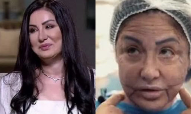 جراء عملية تجميل فاشلة.. فنانة سورية تتعرض للتشوه