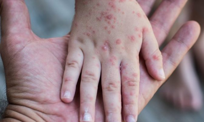 يمكن أن تؤدي الإصابة به إلى الوفاة.. 40 مليون طفل في خطر بسبب تراجع التلقيح ضد الحصبة